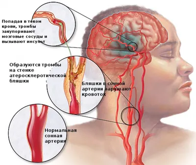 Мозг был залит кровью. После инсульта актер Алексей Янин не может ходить и  говорить | Правмир