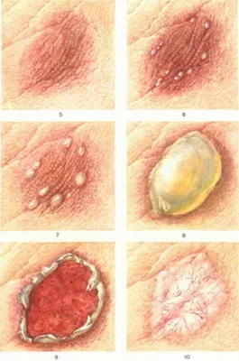 Лучевые поражения - признаки, причины, симптомы, лечение и профилактика -  iDoctor.kz