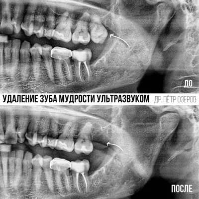 Лунка после удаления зуба мудрости - Хирургическая стоматология -  Стоматология для всех