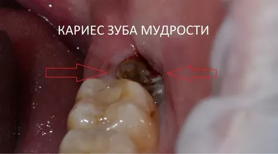 Как заживает лунка после удаления зуба? Фото процесса | Стоматология  Smile-at-Once | Дзен