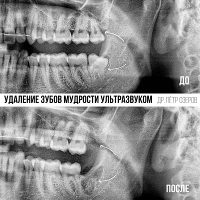 Имплантация собственных зубов. Пересадка зубов мудрости в ТОП1 клинике  Москвы – Немецкий имплантологический центр