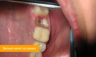 Альвеолит после удаления зуба: фото, лечение, сухая лунка | Dental Art