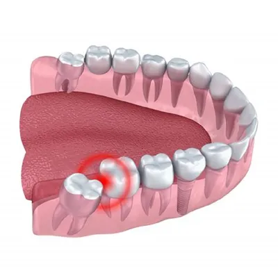 Удаление нижнего зуба мудрости [Цены, осложнения и уход после]