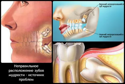 Заживление лунки после удаления зуба