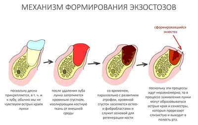 Удаление зубов Харьков - Цены, отзывы, вырвать зуб мудрости