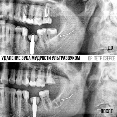 Удаление зуба мудрости на нижней челюсти, цена операции в московской клинике