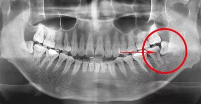 Киста после удаления зуба: кто виноват и как лечить заболевание | Dental Art