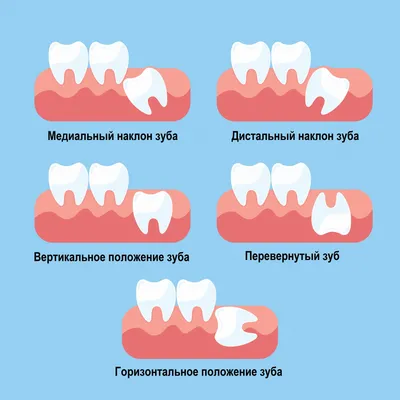 Удаление верхнего и нижнего зубов мудрости в Москве (Текстильщики): цена,  отзывы, фото