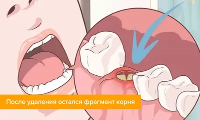 Альвеолит после удаления зуба: фото, лечение, сухая лунка | Dental Art