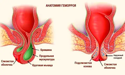 Лечение геморроя: виды, стадии, фото, признаки и причины появления