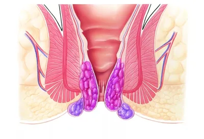Наружный геморрой - причины развития, классификация, симптомы, диагностика,  лечение и профилактика