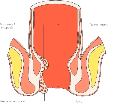💙💙 Наружный геморрой 💙💙 Лечение геморроя в ЗОКБ