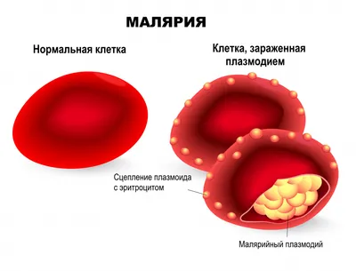 Малярия - причины появления, симптомы заболевания, диагностика и способы  лечения