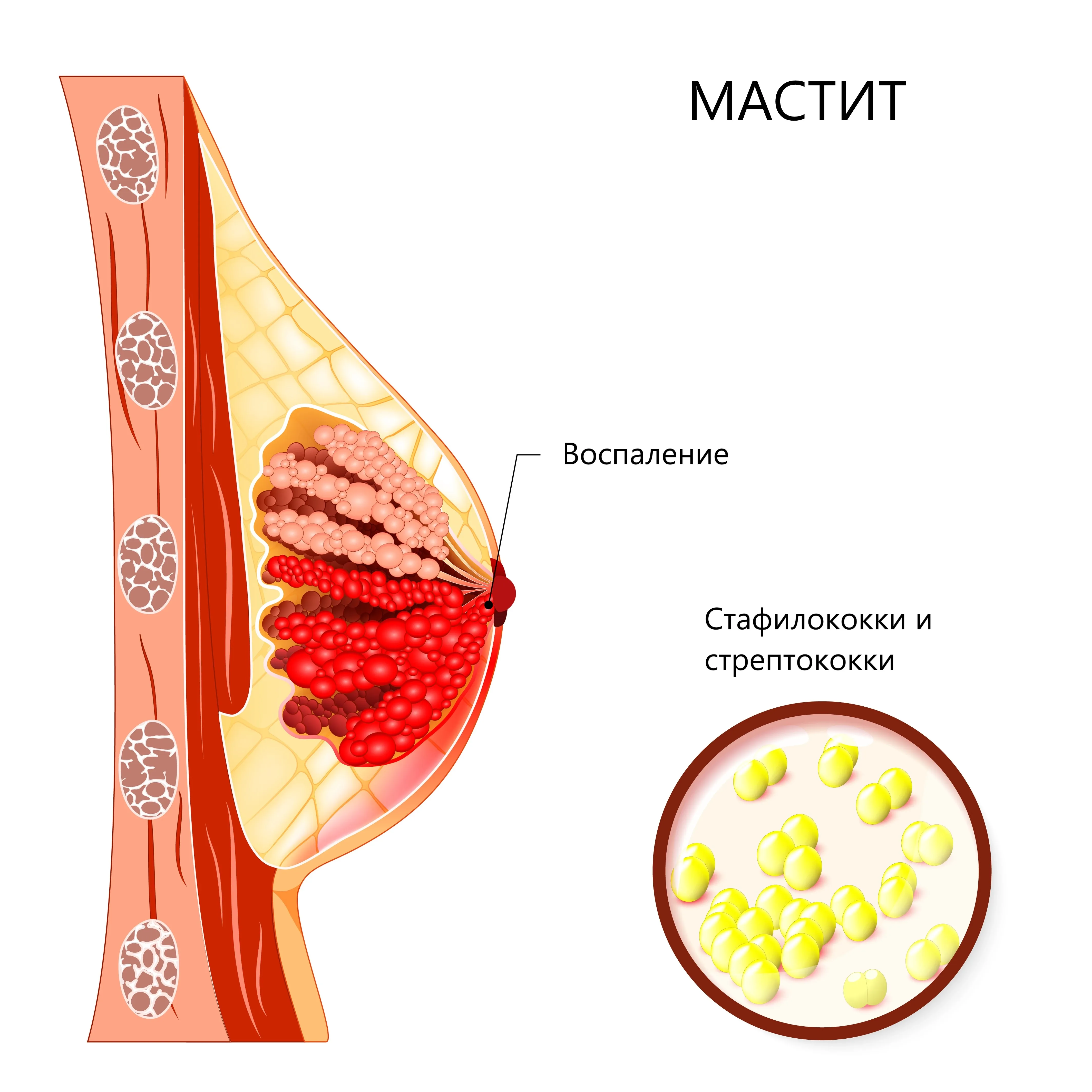 Мастит при грудном вскармливании