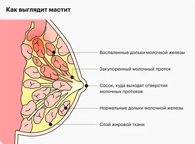 Лактостаз при грудном вскармливании: симптомы, лечение, массаж, отличия от  мастита