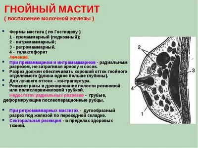 Мастит у женщин - симптомы, причины, диагностика, лечение в СПб