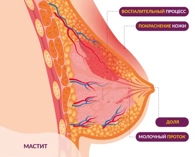 Мастит у кормящей мамы | Москва