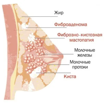 Мастопатия молочных желез - признаки, виды, симптомы и лечение