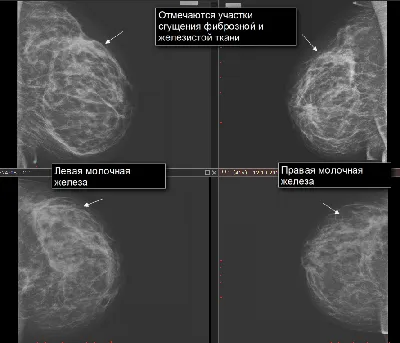 Диффузная фиброзно-кистозная мастопатия – Rentgen.info