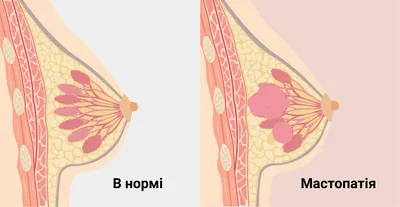 Мастопатия ~ Фиброзно-кистозная болезнь молочной железы