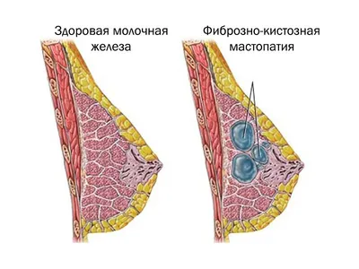 Мастопатия в гинекологической практике : руководство для врачей / И. Ю.  Коган, Е. В. Мусина. 2021 год (ID#1486185764), цена: 480 ₴, купить на  Prom.ua