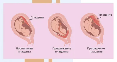 Что такое медикаментозный аборт и как он проводится — блог медицинского  центра ОН Клиник