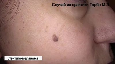 Меланома фото начальная стадия симптомы