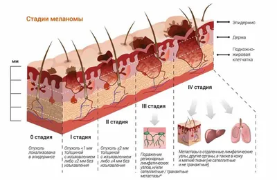 Прогноз при меланоме на 1, 2, 3, 4 стадиях | Стадии меланомы 2024