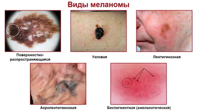 Меланома кожи: стадии, фото и процедура лечения. Онкология