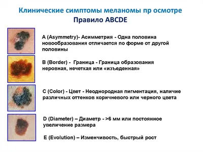 Подногтевая меланома: фото начальной стадии, симптомы и признаки меланомы  ногтя, диагностика и лечение в Москве