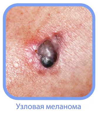 Меланома кожи – лечение в Ужгороде