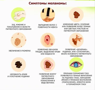 Меланома глаза | Vet Brain | Дзен