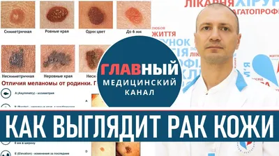 Лечение меланомы в Израиле – лучшие специалисты страны : Armedical