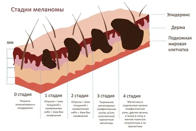 Меланома кожи: признаки, симптомы, начальная стадия