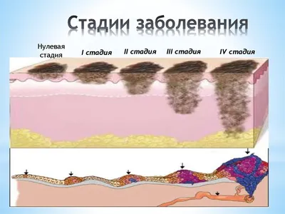 Подногтевая меланома: фото начальной стадии, симптомы и признаки меланомы  ногтя, диагностика и лечение в Москве