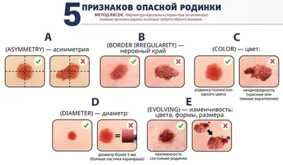 Акральная лентигинозная меланома uMEDp