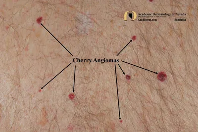 Маленькие красные точки на теле – что они означают и как избавиться от  пятнышек-ангиом, способы лечения