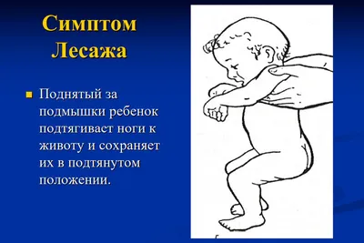 Менингит: признаки и симптомы у детей и взрослых, лечение и осложнения