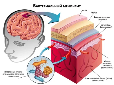 Менингит: симптомы у детей и взрослых, признаки, лекарства, диагностика