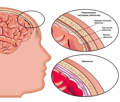 Бактериальный менингит: симптомы, как передается, лечение, профилактика