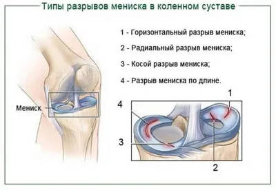 Мениск колена фото