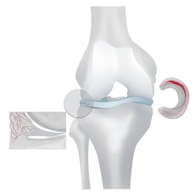 Повреждение мениска - Клиника Новая Медицина в Орехово-Зуево