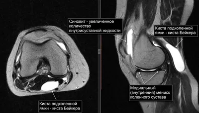 МРТ анатомия менисков коленного сустава | Как выглядят мениски на МРТ -  YouTube