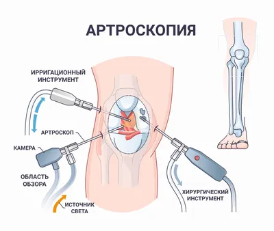 Разрыв мениска (коленного сустава): симптомы, лечение