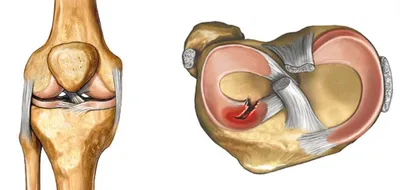 Повреждение менисков (наружного, внутреннего), разрыв/повреждение  крестообразных связок коленного сустава: симптомы, операция, восстановление  – НКЦ №2 (ЦКБ РАН)