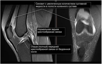 Артроскопия коленного сустава операция в СПб - сделать артроскопию колена,  цены