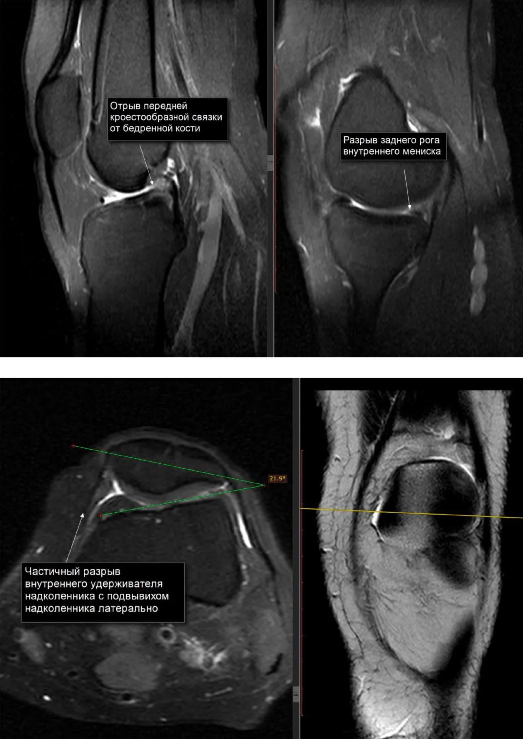 Мениск диагностика. Снимок мрт коленного сустава с разрывом мениска.
