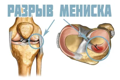 Разрыв мениска / Статья на сайте Волынской больницы от 3 октября 2020 г.