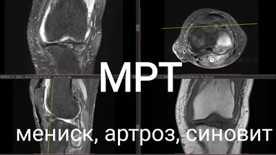 Тейпирование при разрыве медиального мениска коленного сустава в Москве |  Реабилитация в «Центре Спортивной Травмы»