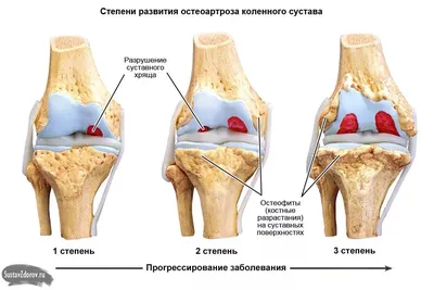 Лечение Повреждение мениска - Ортопедия Руслана Сергиенко